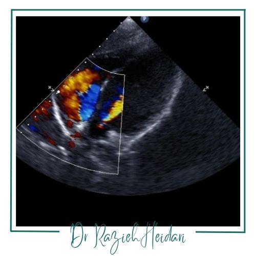 مزایای اولتراسوند داپلر رنگی مزایای اولتراسوند داپلر رنگی