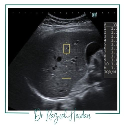 محدودیتهای الاستو سینه محدودیتهای الاستو سینه