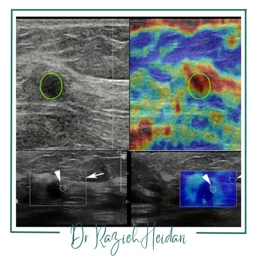 تفسیر نتایج سنجش سفتی تودههای پستان تفسیر نتایج سنجش سفتی تودههای پستان