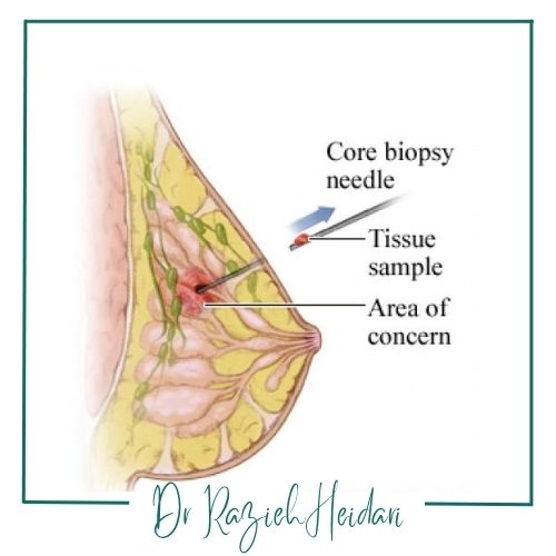 مزایای استفاده از FNA در تشخیص توده مزایای استفاده از FNA در تشخیص توده