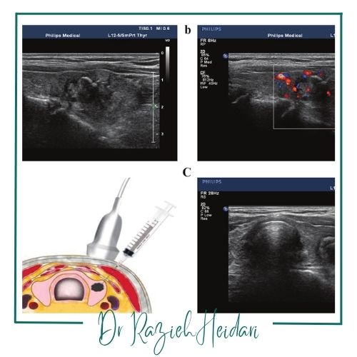 عوارض احتمالی بعد از تست FNA عوارض احتمالی بعد از تست FNA