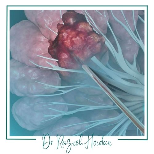 نحوه برداشتن نمونه از بافت پستان نحوه برداشتن نمونه از بافت پستان