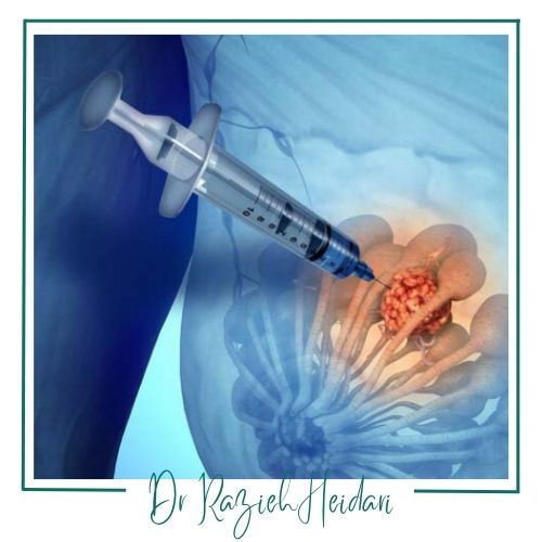 عوارض نمونهبرداری بافتی پستان عوارض نمونهبرداری بافتی پستان