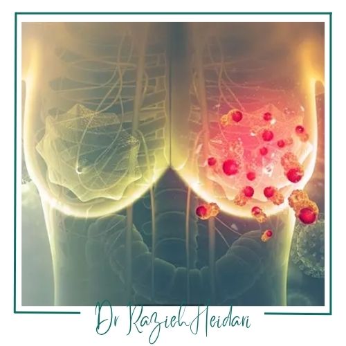 چرا مارکر گذاری سینه انجام میشود؟ چرا مارکر گذاری سینه انجام میشود؟