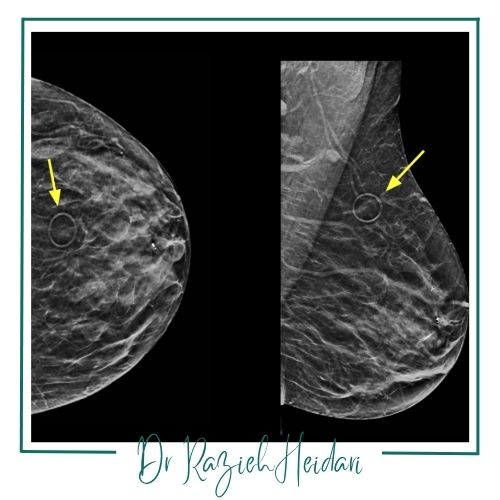 مزایای علامتگذاری پستان مزایای علامتگذاری پستان