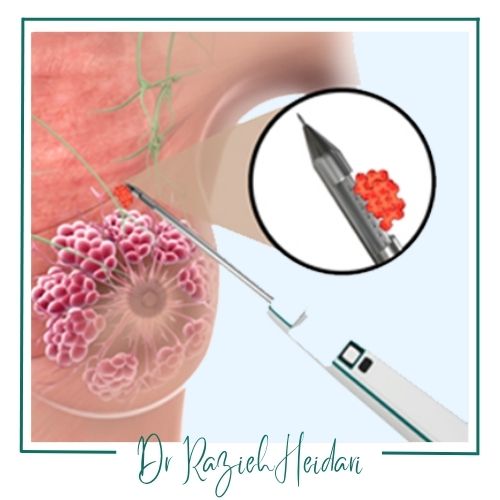 عوارض نقطهگذاری پستان برای نمونهبرداری عوارض نقطهگذاری پستان برای نمونهبرداری