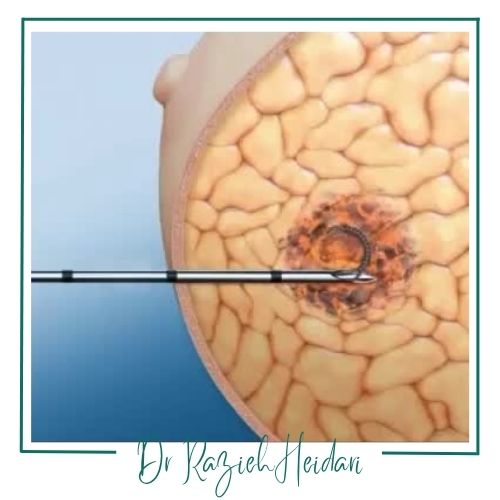 فرآیند نشانهگذاری پستان فرآیند نشانهگذاری پستان