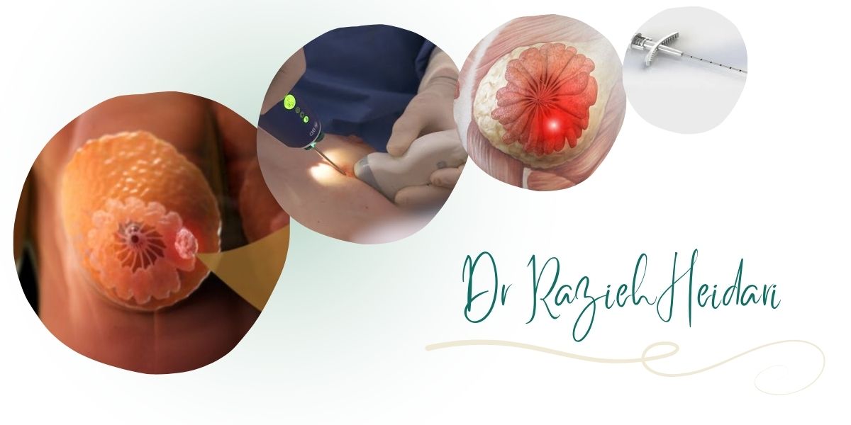 دکتر حیدری بهترین مرکز مارکرگذاری پستان در تهران دکتر حیدری بهترین مرکز مارکرگذاری پستان در تهران