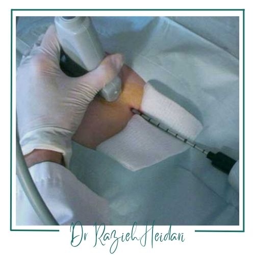 مزایای بیوپسی پستان با دستگاه مکنده مزایای بیوپسی پستان با دستگاه مکنده