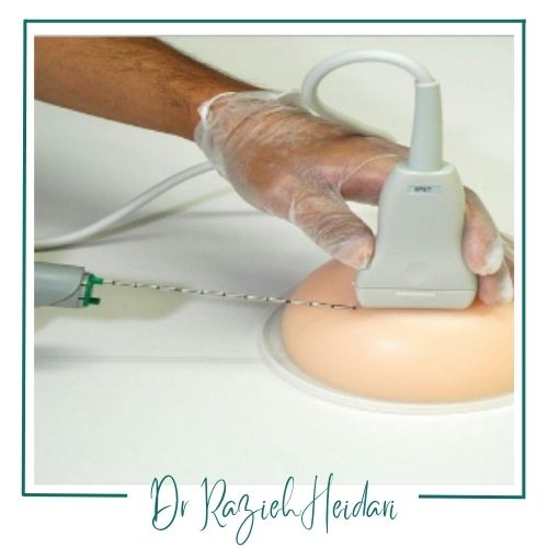 کاربردهای وکیوم بیوپسی سینه کاربردهای وکیوم بیوپسی سینه