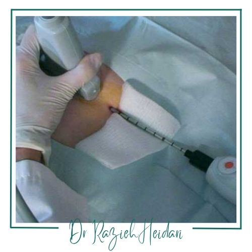 عوارض نمونهبرداری با وکیوم از سینه عوارض نمونهبرداری با وکیوم از سینه