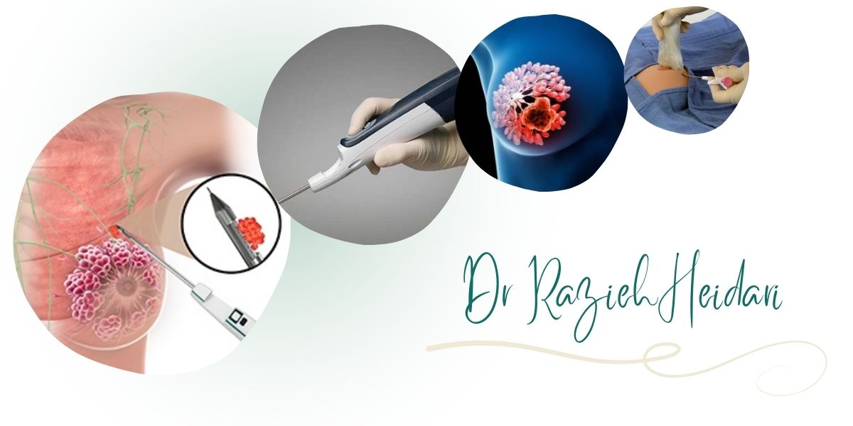 دکتر حیدری بهترین مرکز وکیوم بیوپسی پستان در تهران دکتر حیدری بهترین مرکز وکیوم بیوپسی پستان در تهران