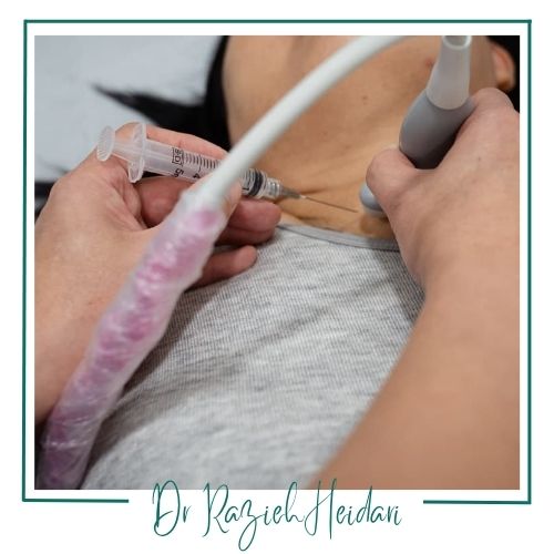 نحوه انجام بیوپسی تیروئید نحوه انجام بیوپسی تیروئید