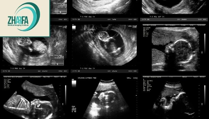 مزایای اولتراسوند بارداری