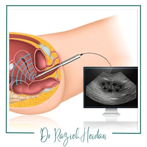 مراحل انجام سونو واژن