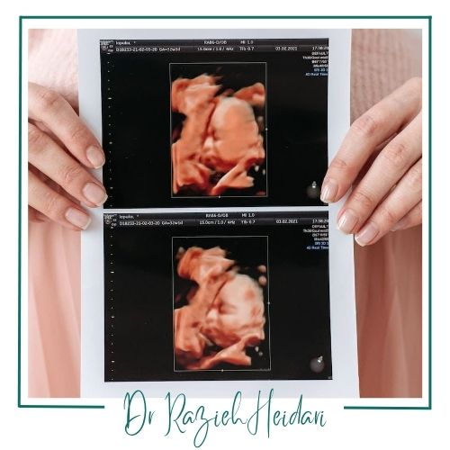سونوگرافی داپلر جنین سونوگرافی داپلر جنین