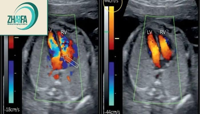 سونوگرافی کالر داپلر پستان سونوگرافی کالر داپلر پستان