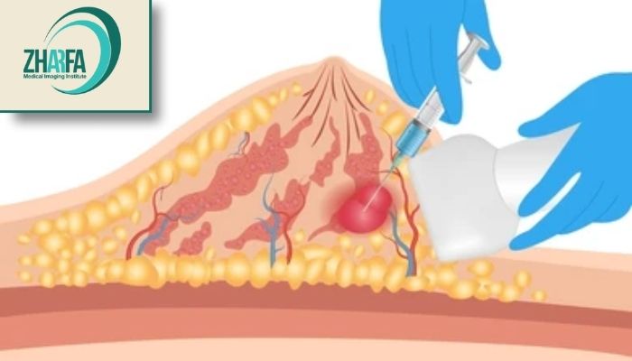 مراقبت‌های اولیه در محل بیوپسی