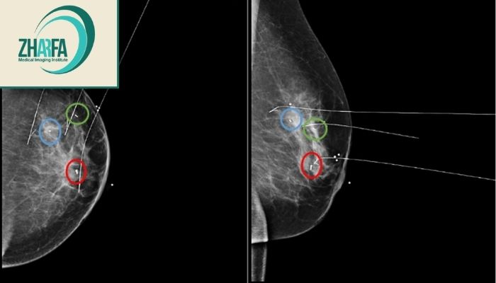 چرا وایرگذاری پستان لازم است؟ 