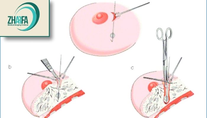 مراحل انجام وایرگذاری