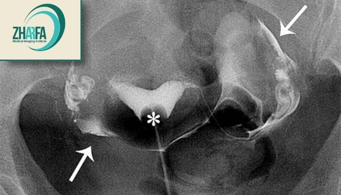 در چه مواردی عکس رنگی رحم (HSG) باید تکرار شود؟