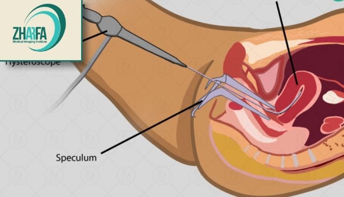 دلیل محدودیت هیستروسالپنگوگرافی 