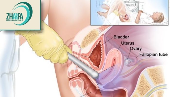 تشخیص آندومتریوز با سونوگرافی