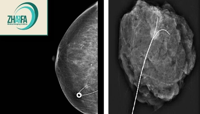 تفاوت درد وایرگذاری پستان با درد جراحی