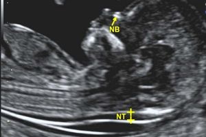 سونوگرافی NT سونوگرافی NT