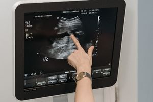 سونوگرافی تعیین جنسیت سونوگرافی تعیین جنسیت