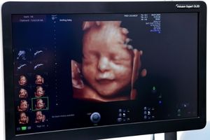 سونوگرافی آنومالی اسکن پیشرفته سونوگرافی آنومالی اسکن پیشرفته
