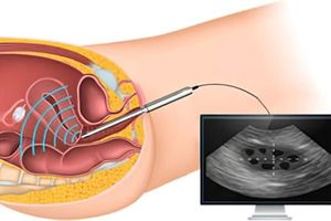 سونوهیستروگرافی سونوهیستروگرافی