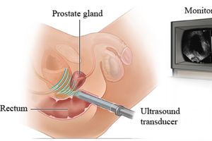 سونوگرافی رکتال سونوگرافی رکتال