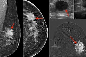 سونوگرافی پستان سونوگرافی پستان