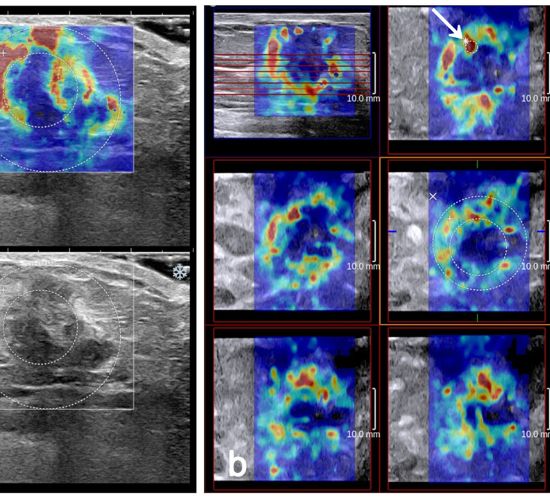 الاستوگرافی پستان