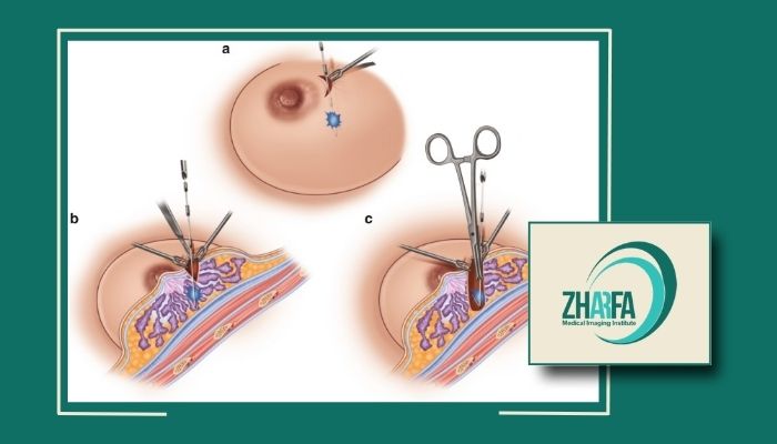 آیا وایرگذاری پستان درد دارد؟ آنچه باید بدانید