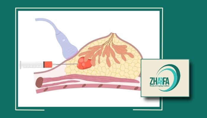 بعد از بیوپسی پستان به چه مراقبت هایی نیاز است؟