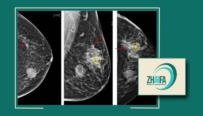 مارکرگذاری پستان در تهران توسط پزشک خانم با تکنیک نوین مارکرگذاری پستان در تهران توسط پزشک خانم با تکنیک نوین