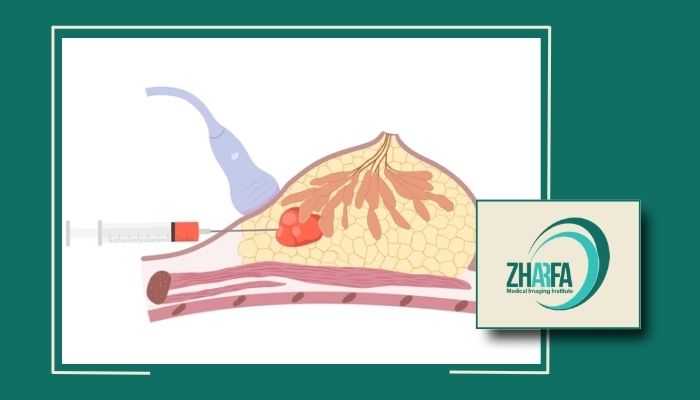 FNA پستان چیست و چگونه انجام می شود؟ FNA پستان چیست و چگونه انجام می شود؟