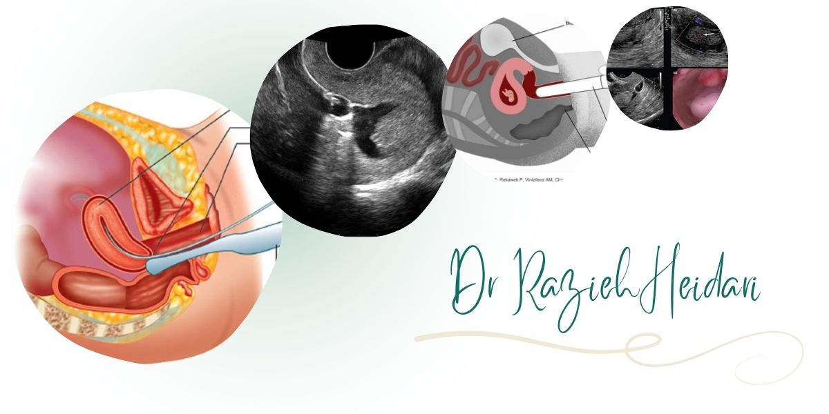 چرا دکتر حیدری بهترین متخصص سونوهیستروگرافی در شرق تهران است؟