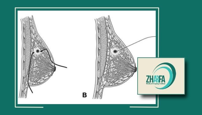 چرا وایرگذاری پستان برای برخی بیماران ضروری است؟